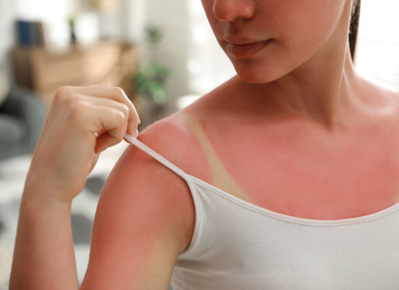 Přepískli jste to s pobytem na slunci? 13 tipů, čím ošetřit spálenou kůži