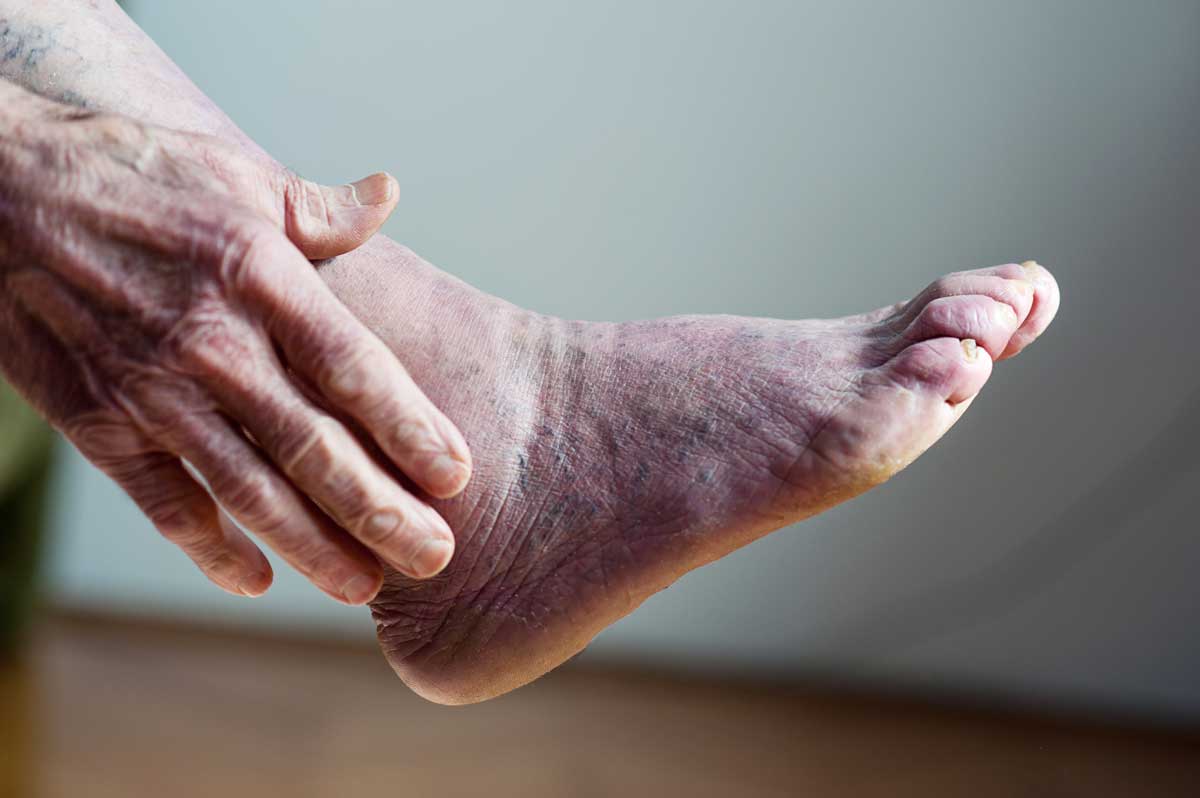 Namodralá kůže na chodidle jako možný projev špatného prokrvení končetin